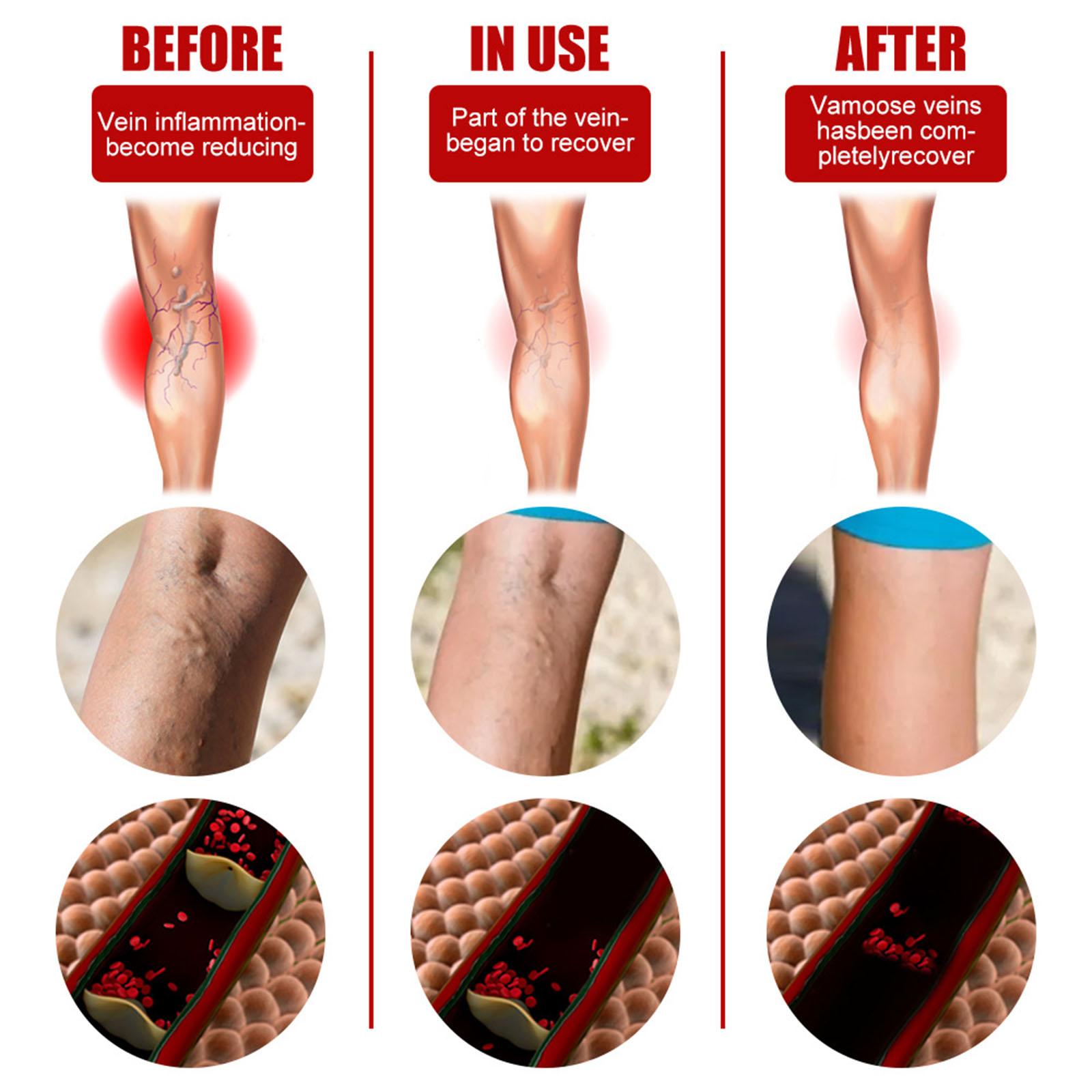 6pcs Vein massage varicose leg vein patch with optional pen without pen