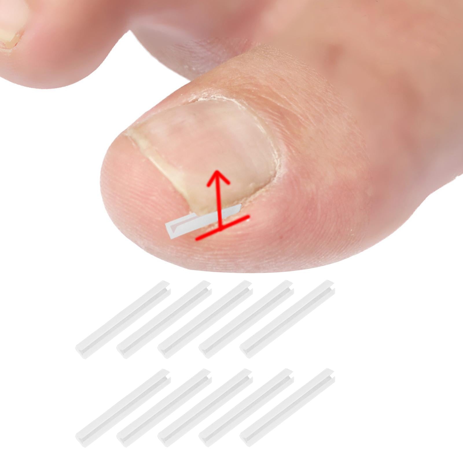 Ingrown Toenail Corrector Strips Curved Toenail Corrector Foot Care