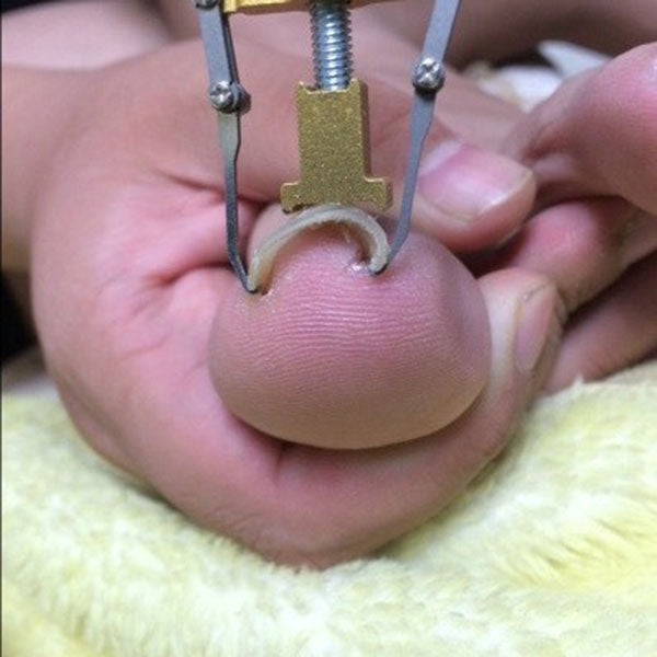 Ingrown-Toenails-Pedicure-Foot-Nail-Care-Tools-Bunion-Corrector-for-Toes